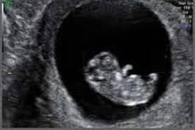 Early Pregnancy Scan from 6 Weeks | Private Ultrasound | Baby Grows ...